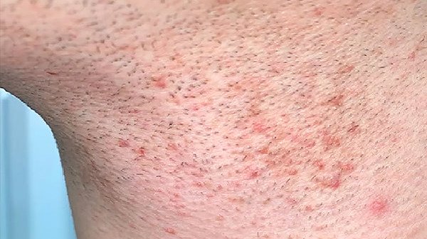 Как бриться без раздражения